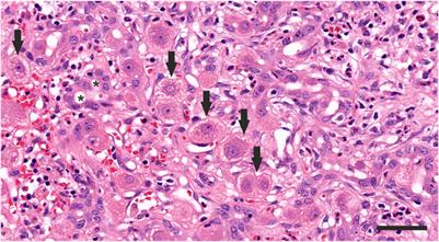 Acute severe hepatitis outbreak in children: A perfect storm. What do we know, and what questions remain?